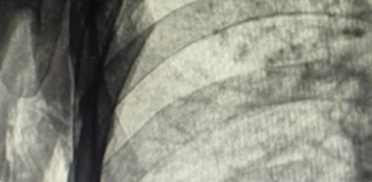 В Балакове госпитализировали школьницу, проглотившую гвоздь В Балакове госпитализировали школьницу, проглотившую гвоздь